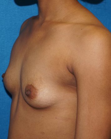 Breast Augmentation