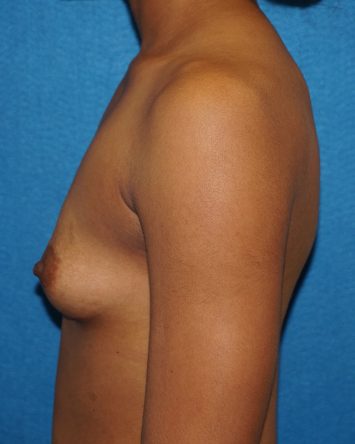 Breast Augmentation