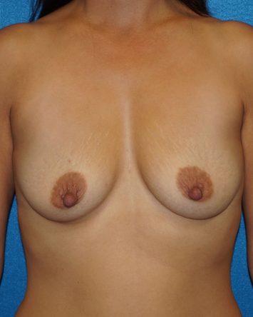 Breast Augmentation