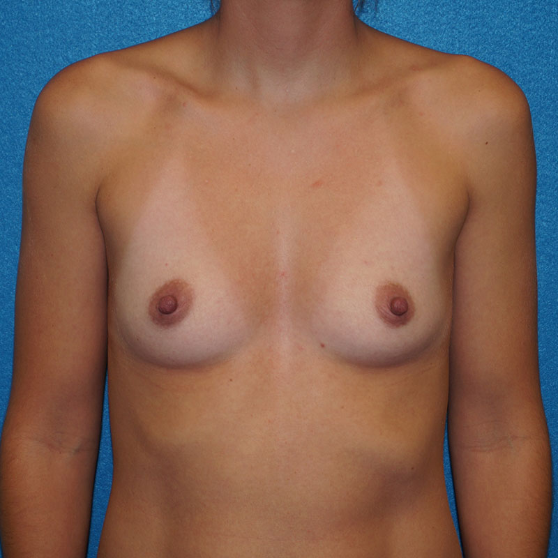 Breast Augmentation