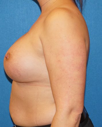 Breast Augmentation