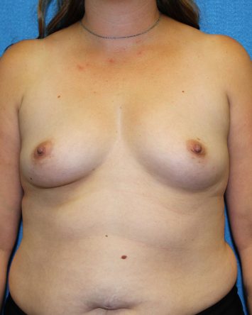 Breast Augmentation