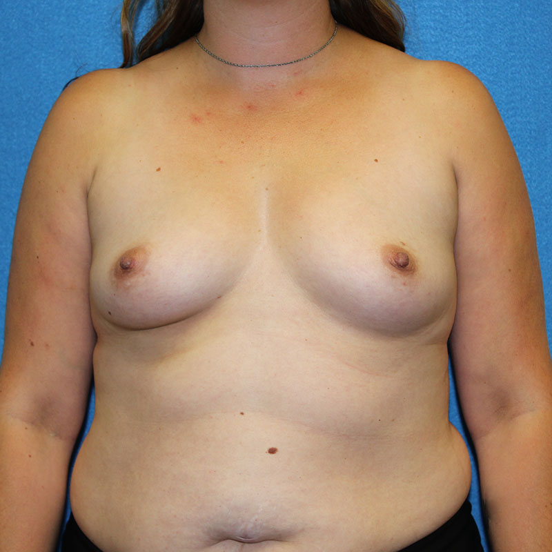 Breast Augmentation