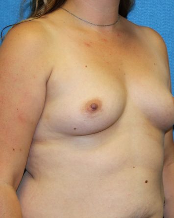 Breast Augmentation