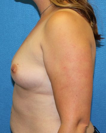 Breast Augmentation