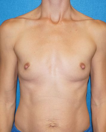 Breast Augmentation