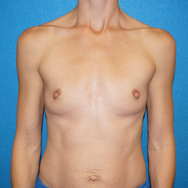 Breast Augmentation