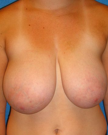 Breast Reduction