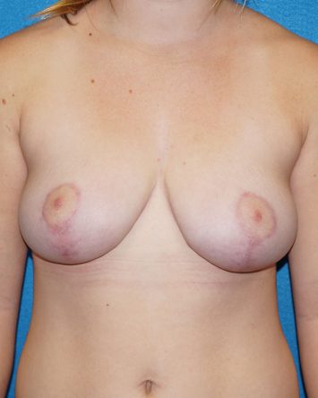 Breast Reduction