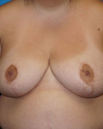 Breast Reduction