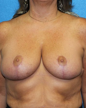 Breast Reduction