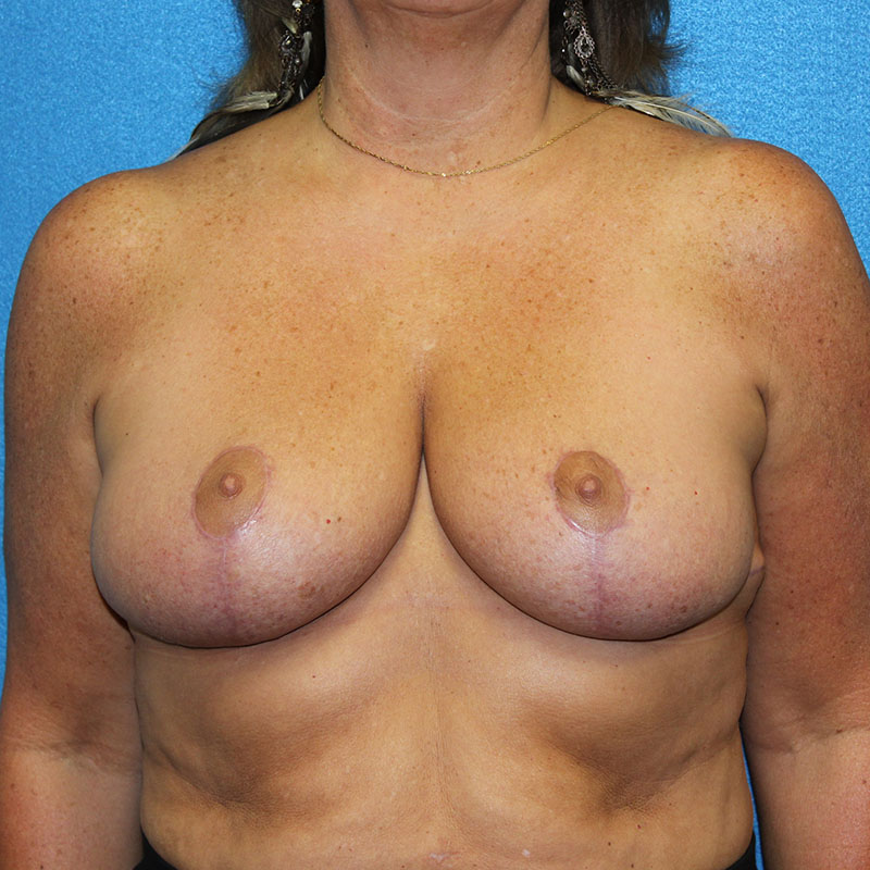 Breast Reduction