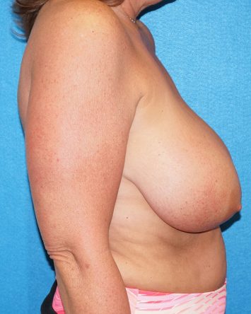 Breast Reduction