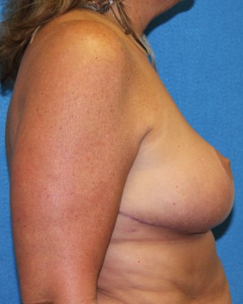 Breast Reduction