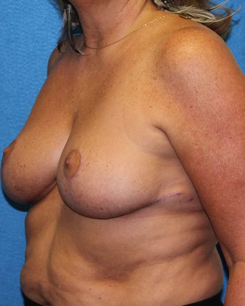 Breast Reduction