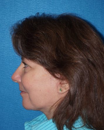 Facelift/Necklift