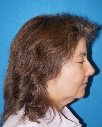 Facelift/Necklift