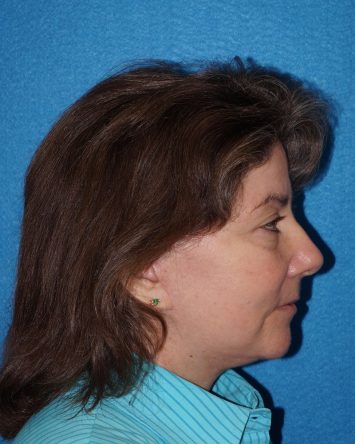 Facelift/Necklift