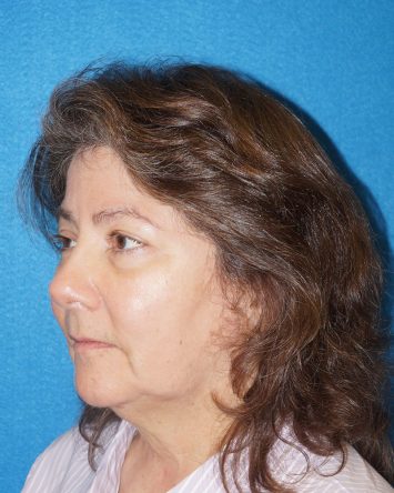 Facelift/Necklift