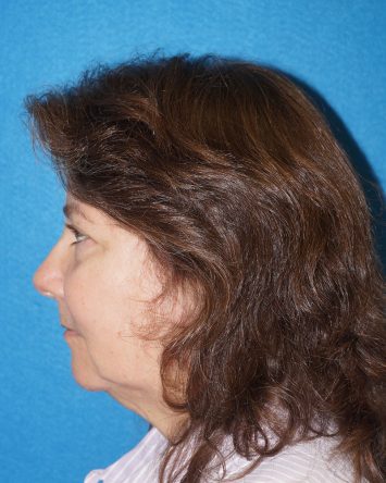 Facelift/Necklift