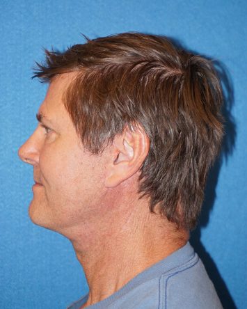 Facelift/Necklift