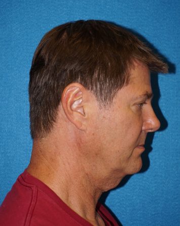 Facelift/Necklift