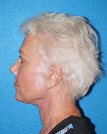 Facelift/Necklift