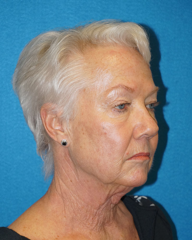 Facelift/Necklift