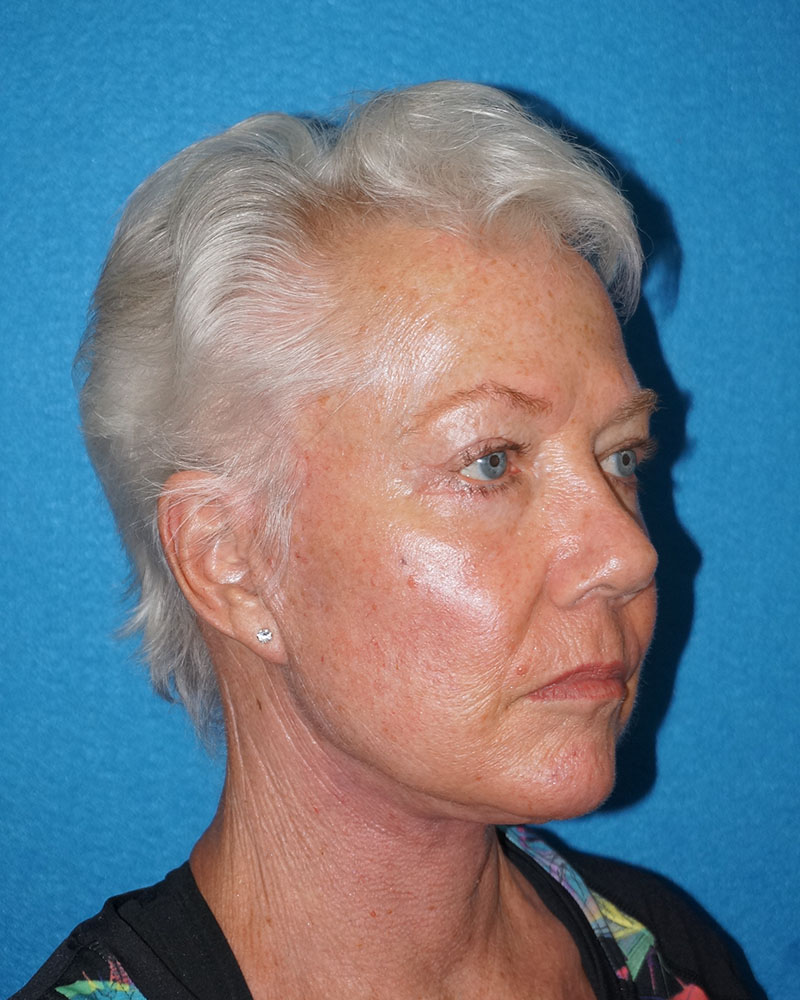 Facelift/Necklift