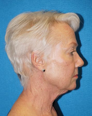 Facelift/Necklift