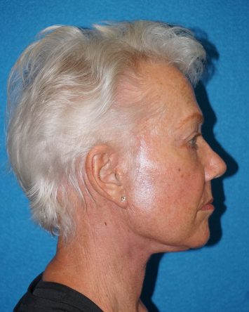 Facelift/Necklift