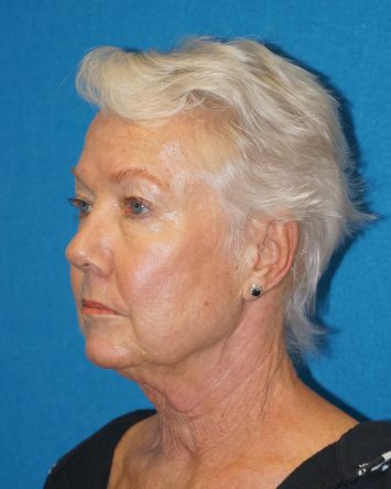 Facelift/Necklift