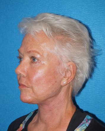 Facelift/Necklift