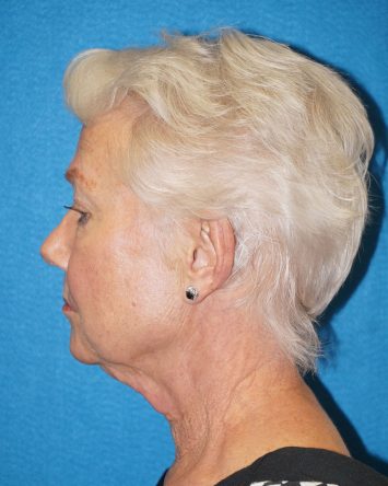 Facelift/Necklift