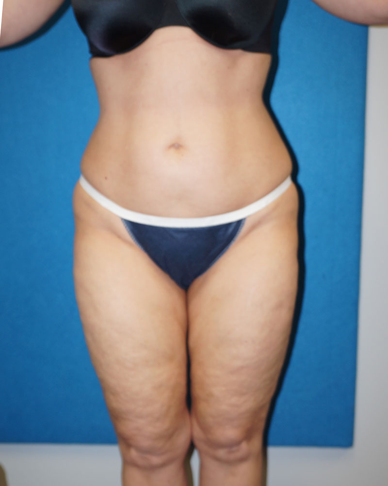 Liposuction