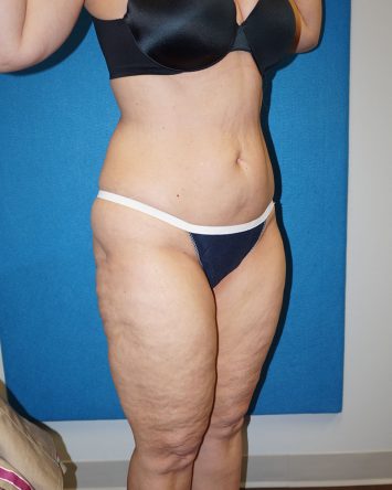 Liposuction