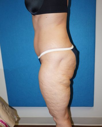 Liposuction