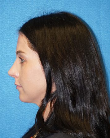 Rhinoplasty