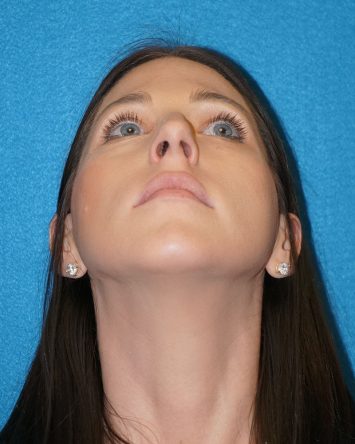 Rhinoplasty