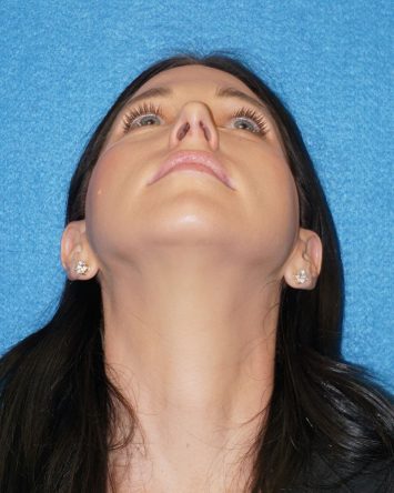 Rhinoplasty