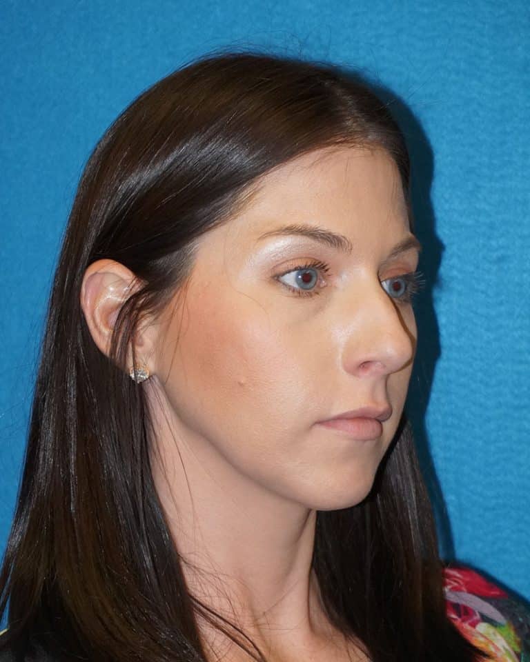 Sacramento Rhinoplasty Before and After Photos Roseville Plastic Surgery Photo Gallery The