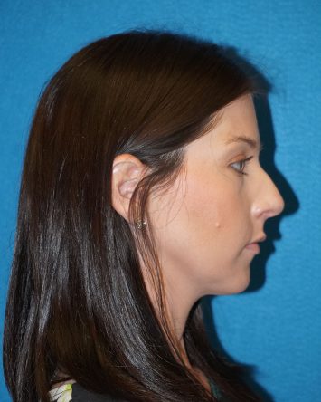 Rhinoplasty