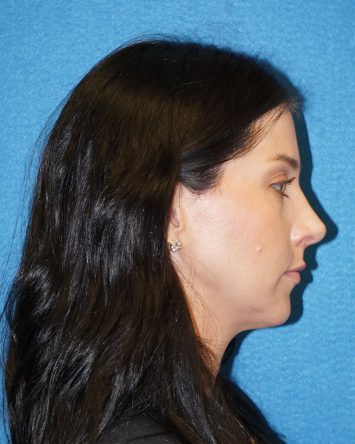 Rhinoplasty