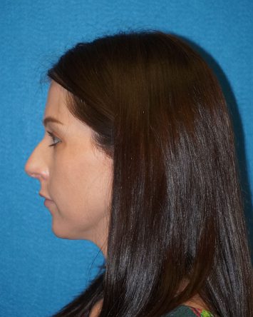 Rhinoplasty