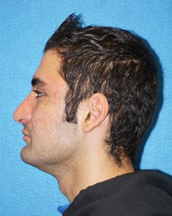 Rhinoplasty