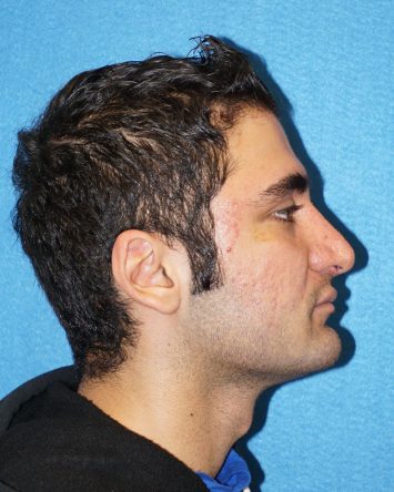 Rhinoplasty