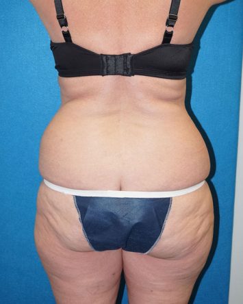 Tummy Tuck