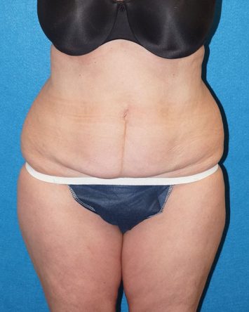 Tummy Tuck