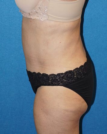 Tummy Tuck