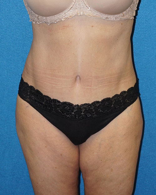 Tummy Tuck